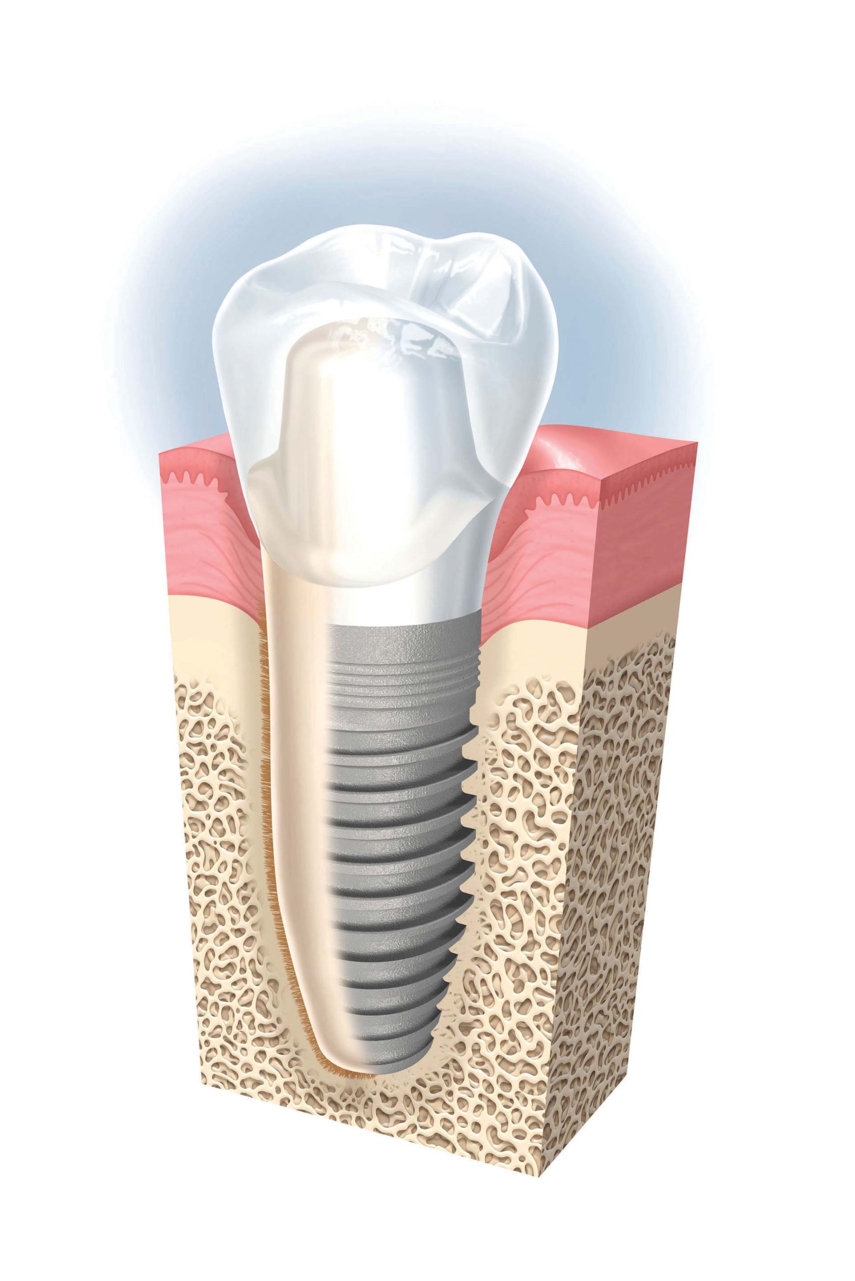 Implant dentaire