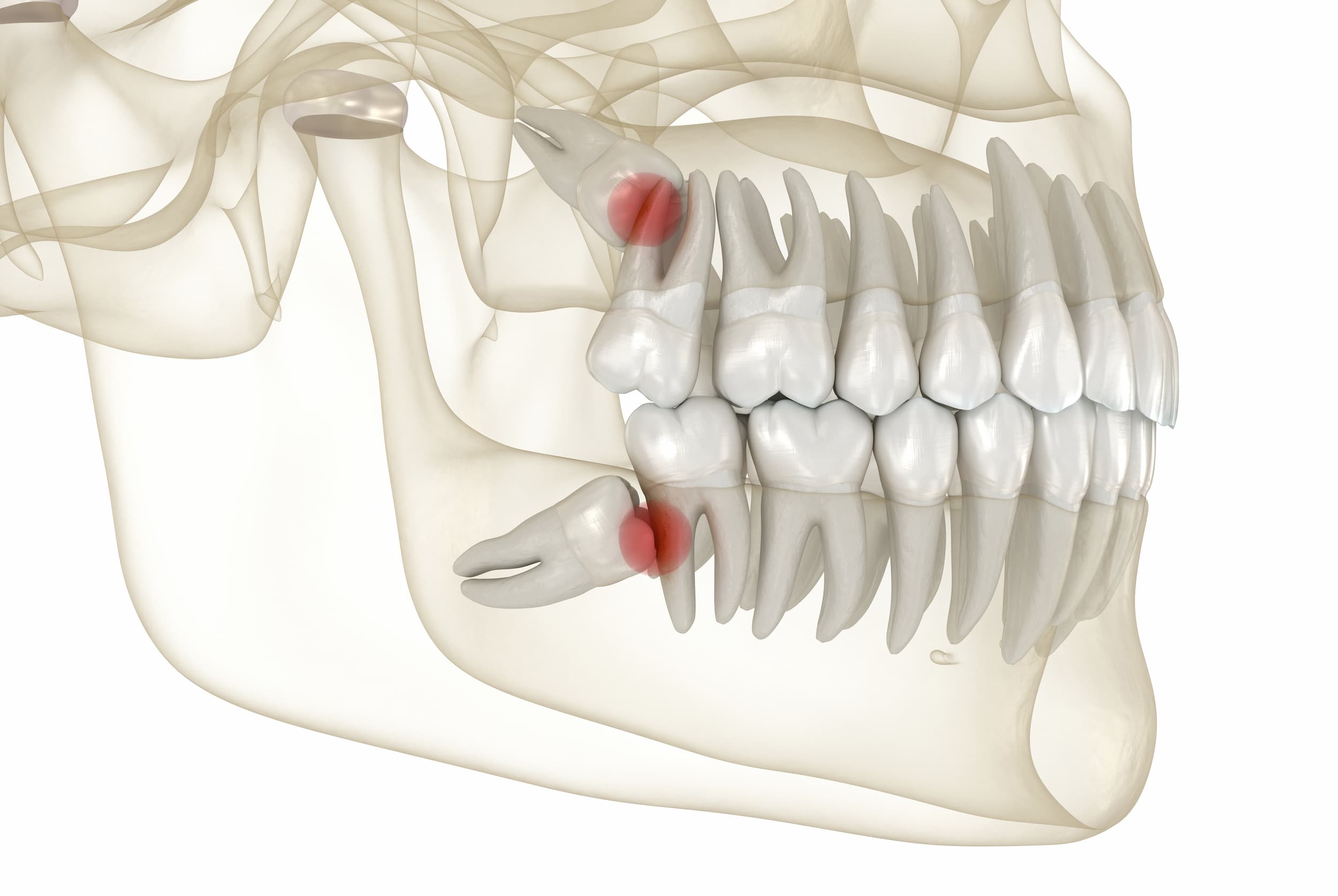 Dents de sagesse