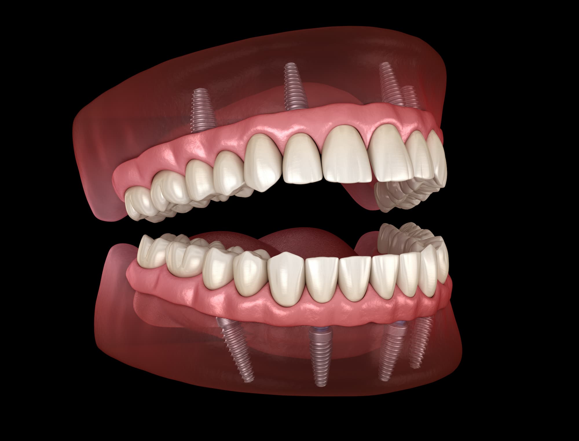 Prothèse complète fixe sur implants